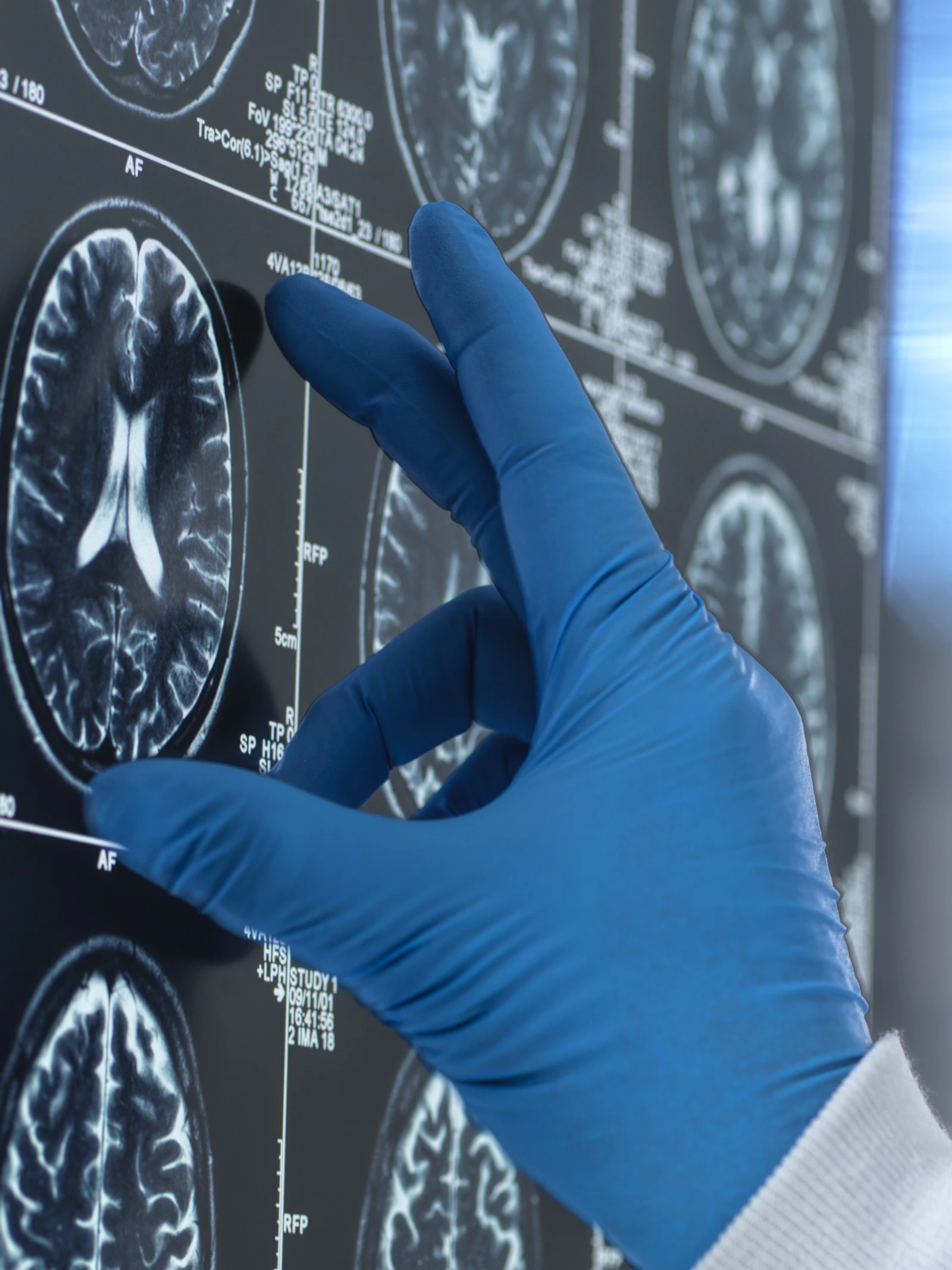Kunnen sommige kankermedicijnen ook alzheimer verslaan?