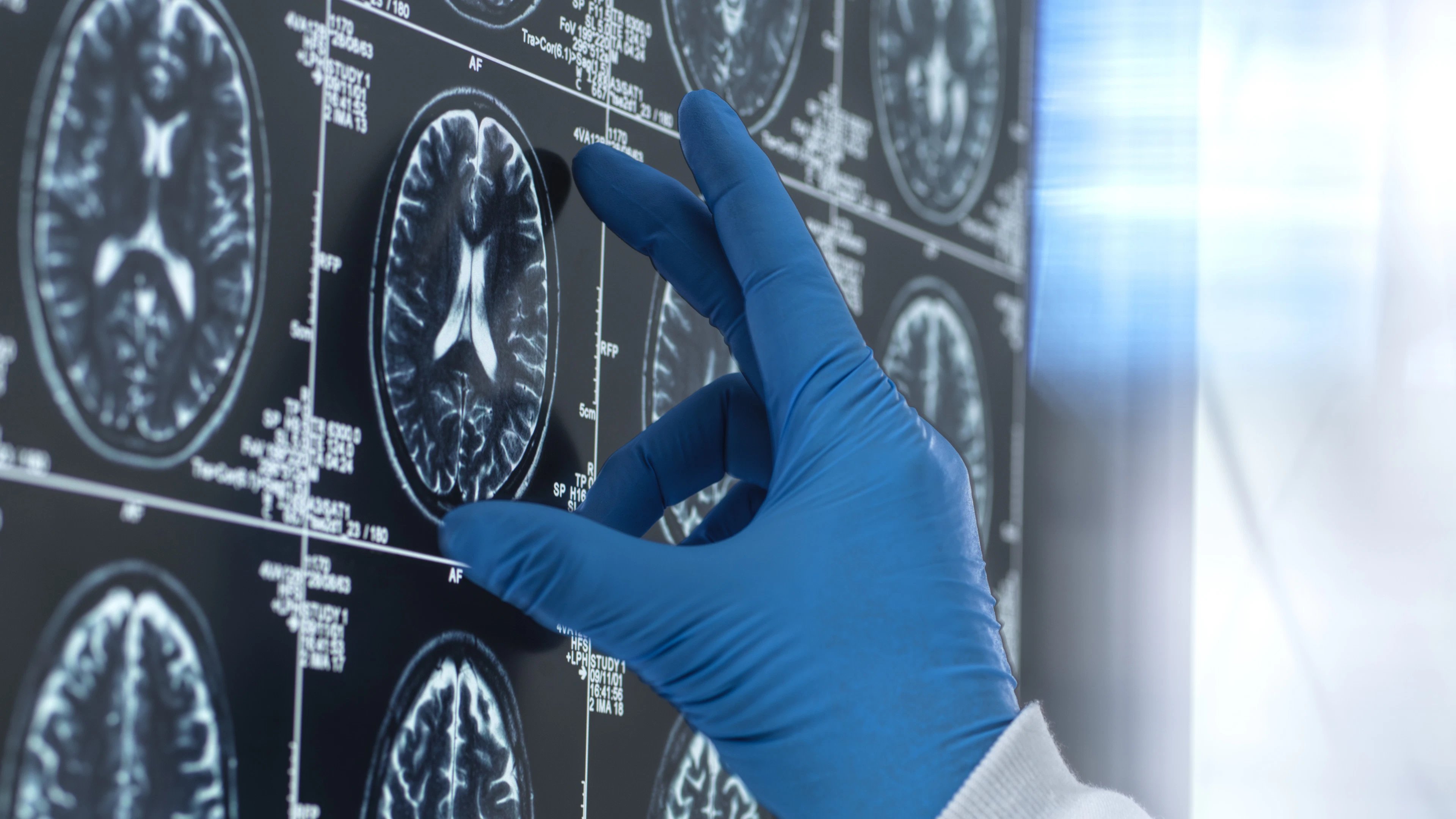 Kunnen sommige kankermedicijnen ook alzheimer verslaan?