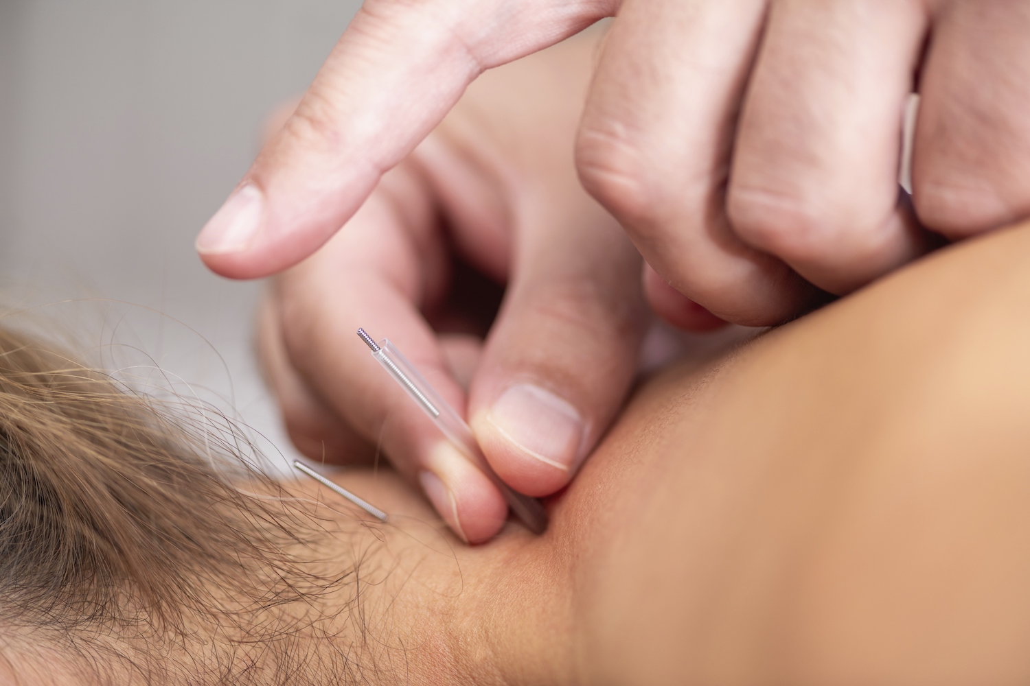 De voordelen van dry needling zijn onvoldoende bewezen, vooral op langere termijn