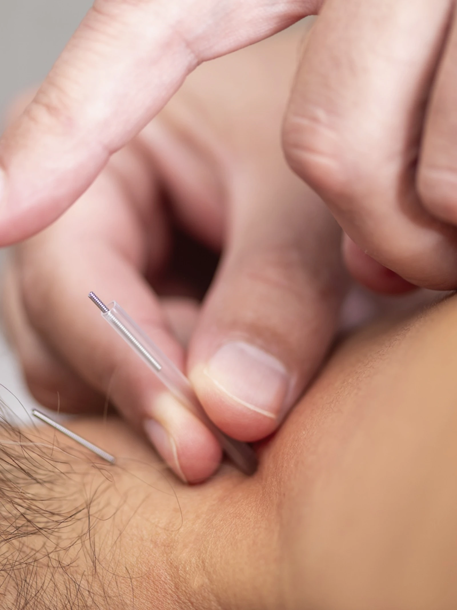 De voordelen van dry needling zijn onvoldoende bewezen, vooral op langere termijn