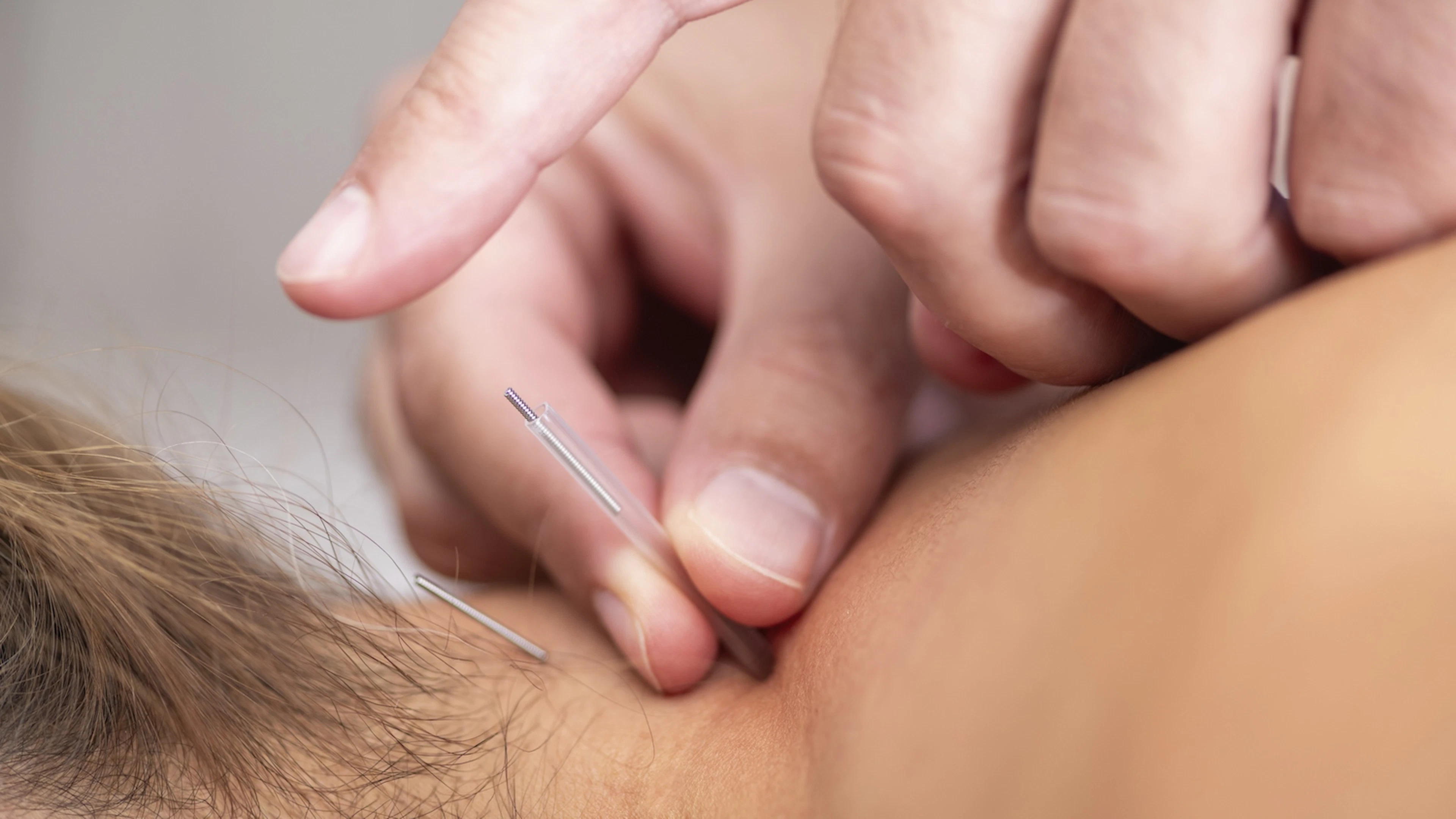 De voordelen van dry needling zijn onvoldoende bewezen, vooral op langere termijn
