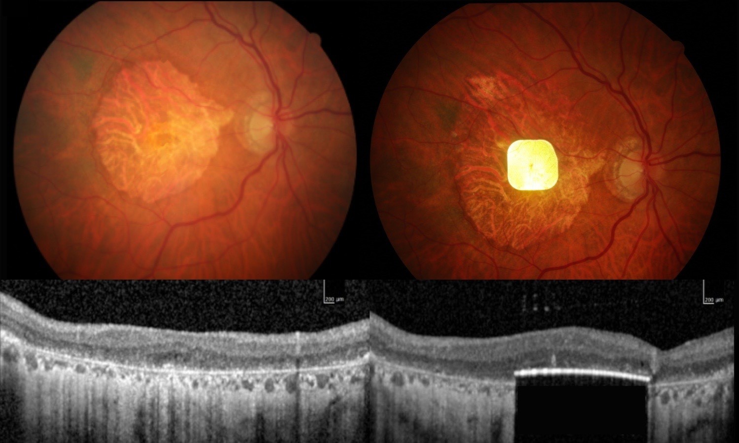 Chip in oog herstelt zicht