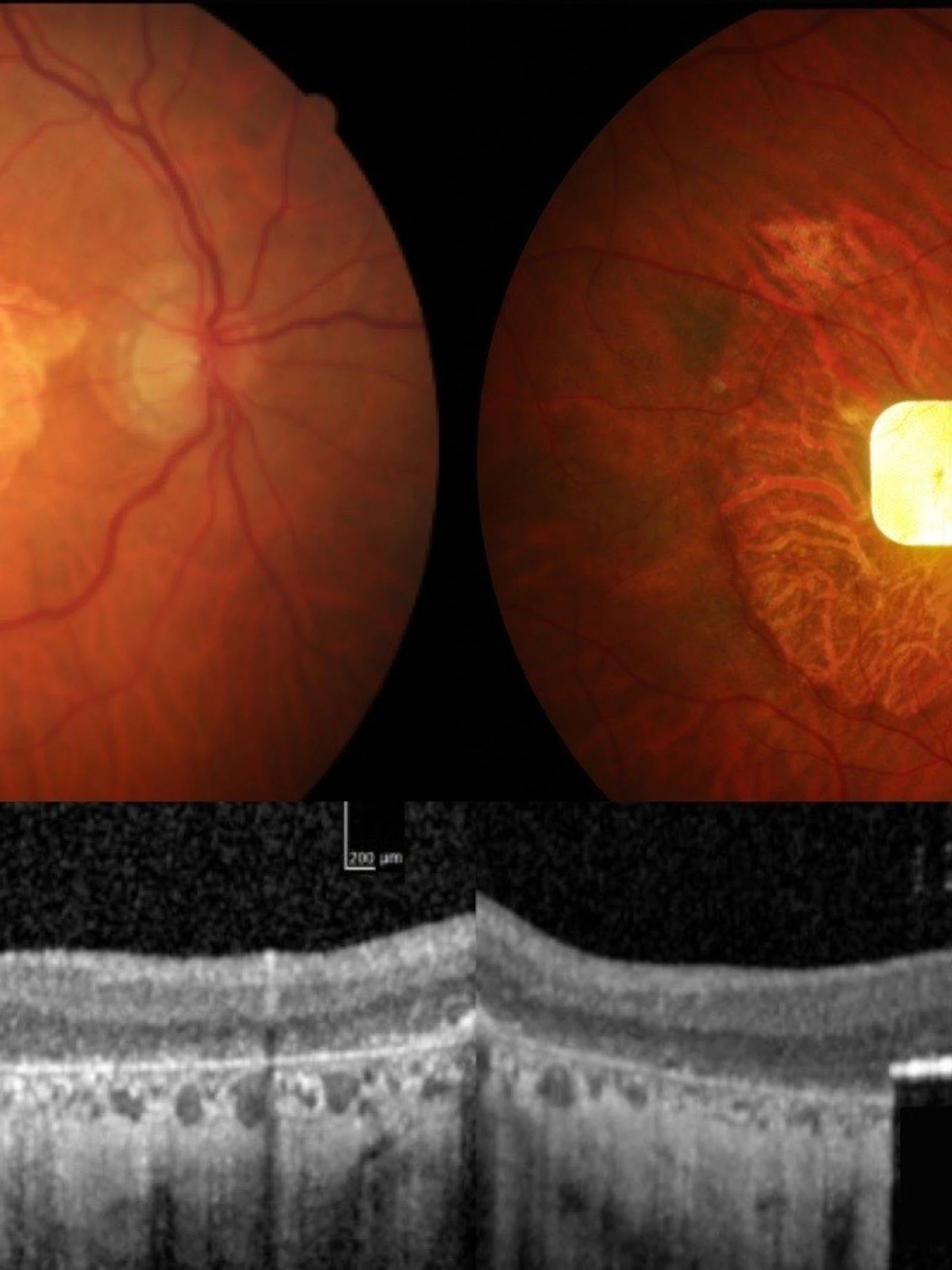 Chip in oog herstelt zicht
