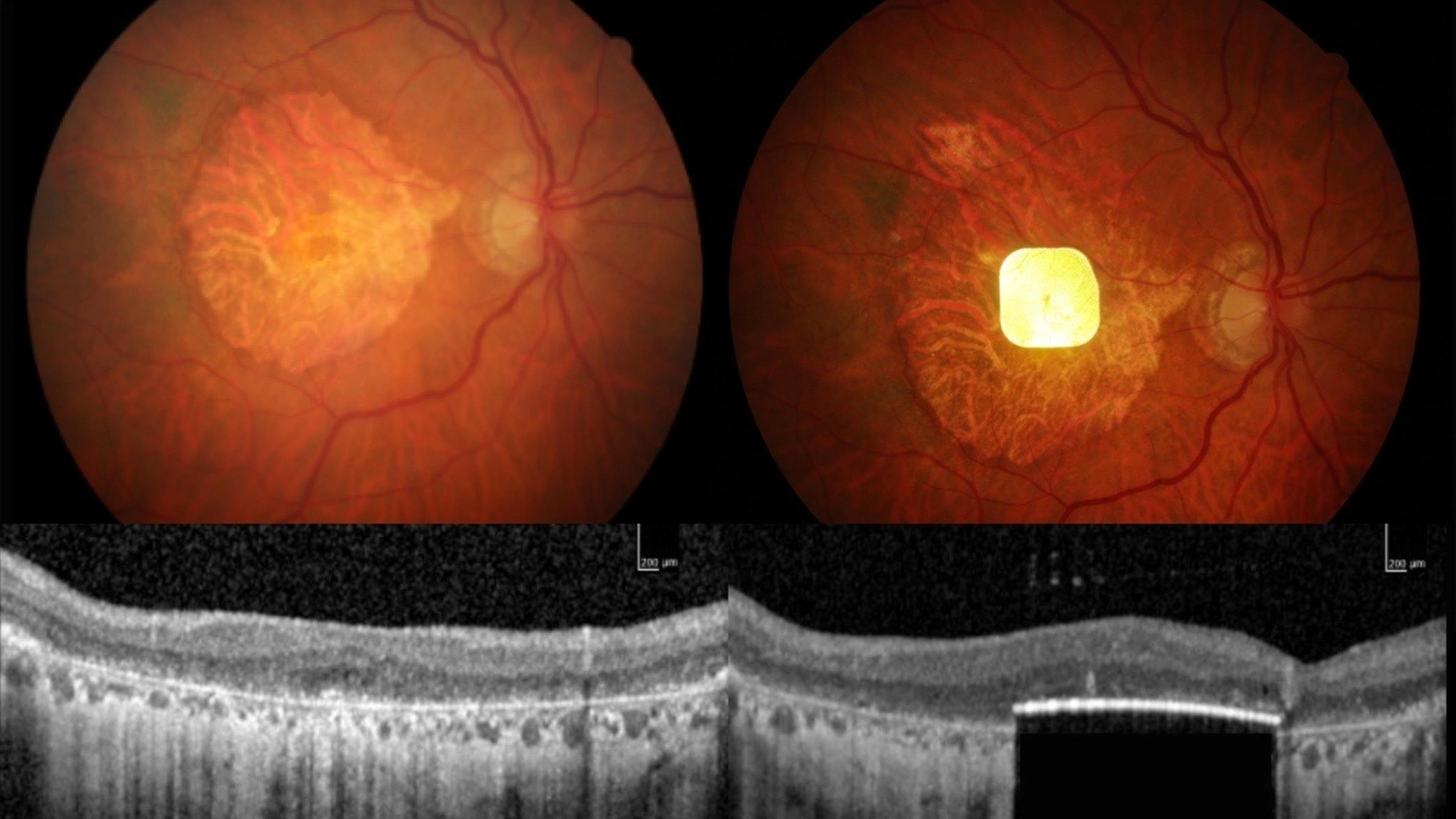 Chip in oog herstelt zicht