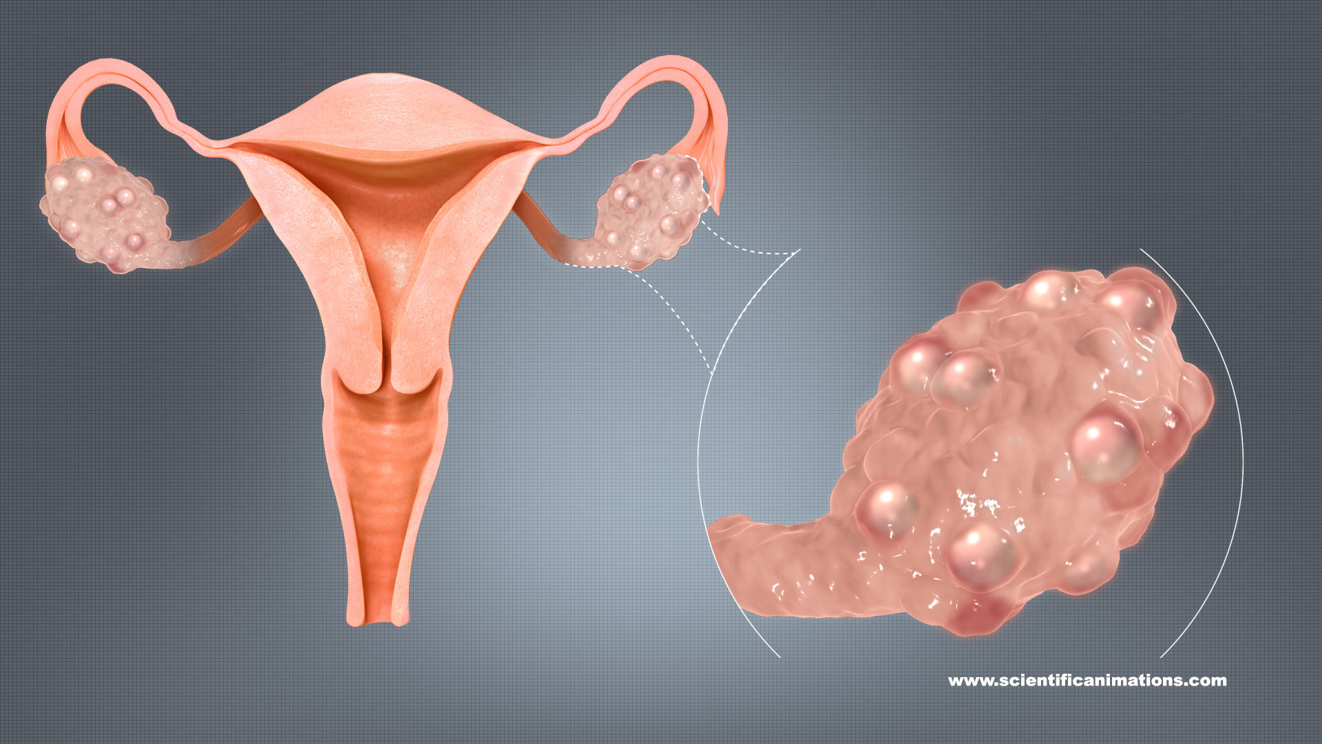 Mysterieus syndroom: PCOS zou ook mannen treffen