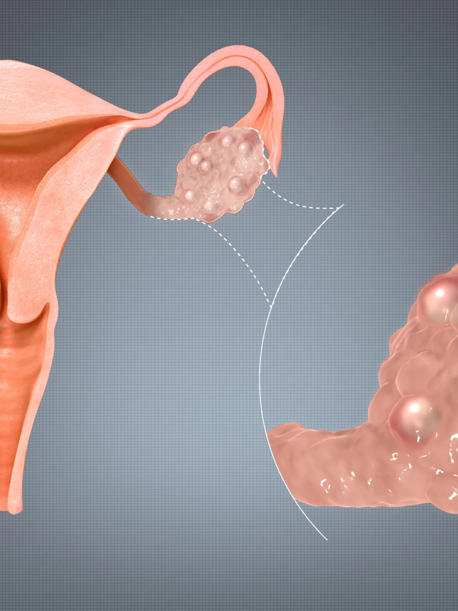 Mysterieus syndroom: PCOS zou ook mannen treffen