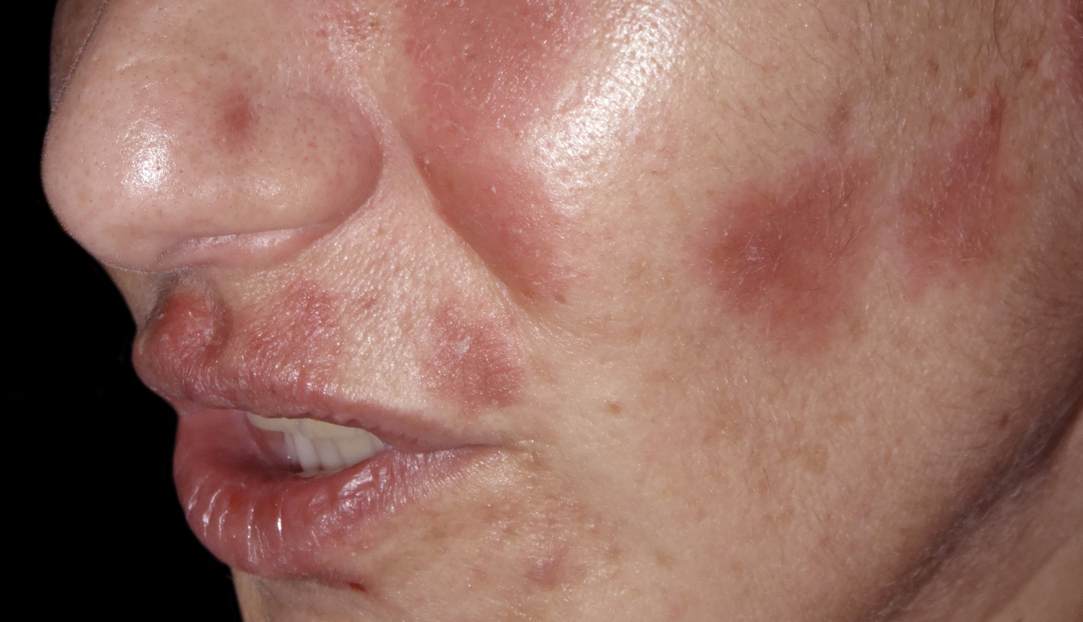 Minder psoriasisklachten met minder middelen