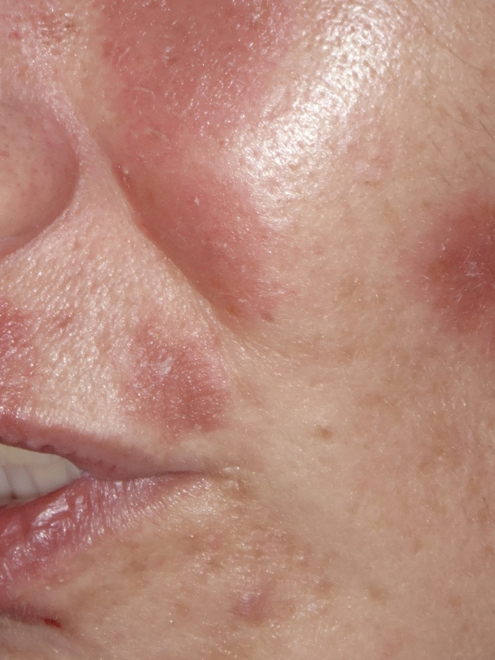 Minder psoriasisklachten met minder middelen