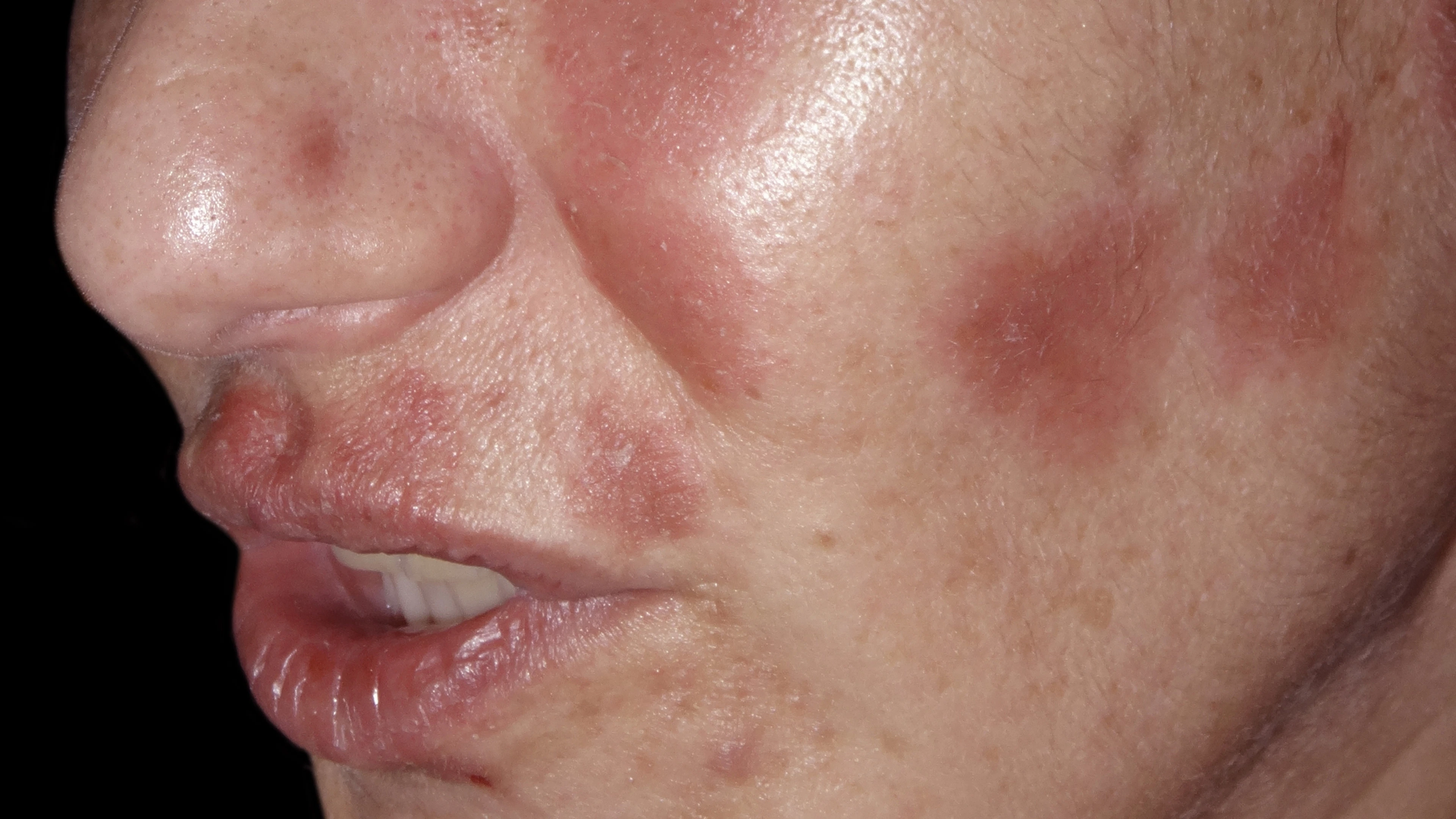 Minder psoriasisklachten met minder middelen