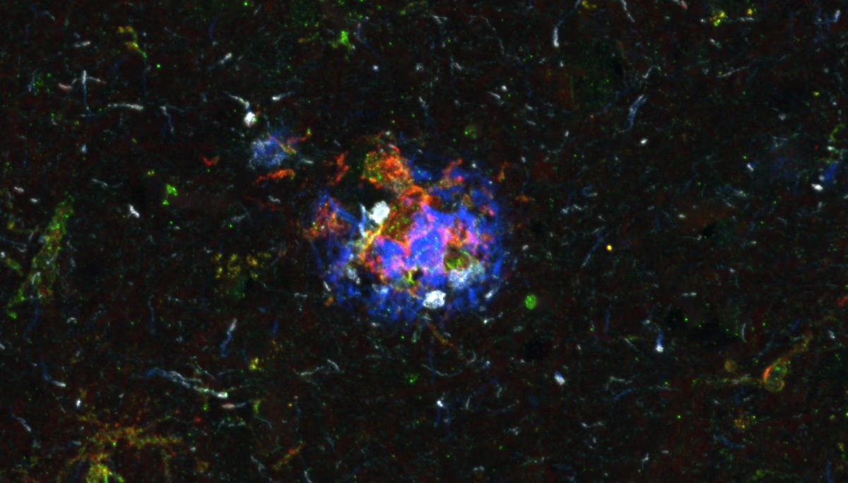 Hoe sommige breinen alzheimer weerstaan