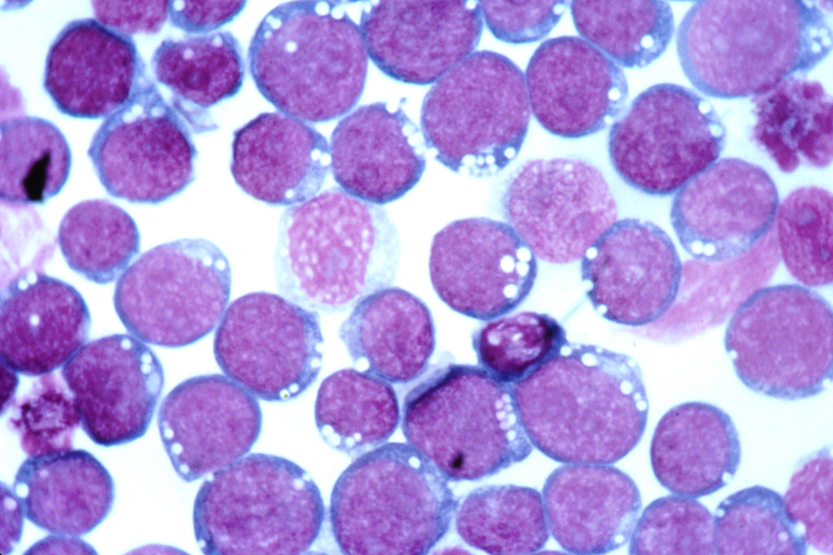 Nieuw onderzoek vindt puzzelstukje van link tussen Epstein-Barr-virus en MS