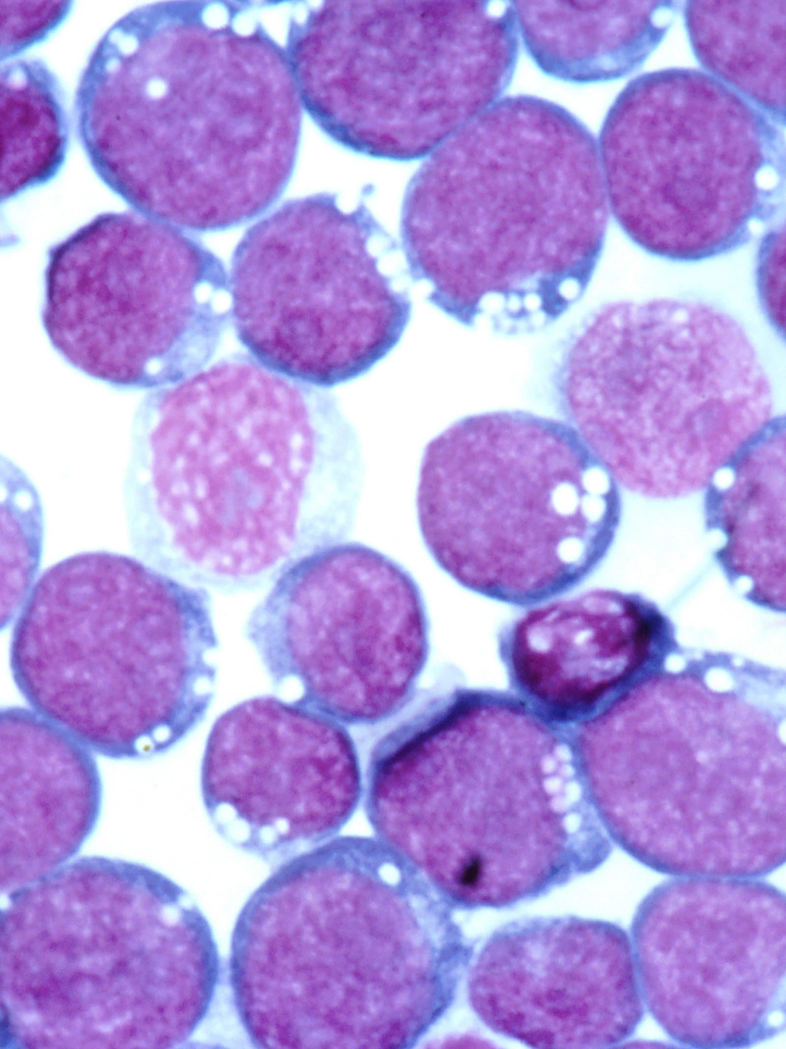 Nieuw onderzoek vindt puzzelstukje van link tussen Epstein-Barr-virus en MS