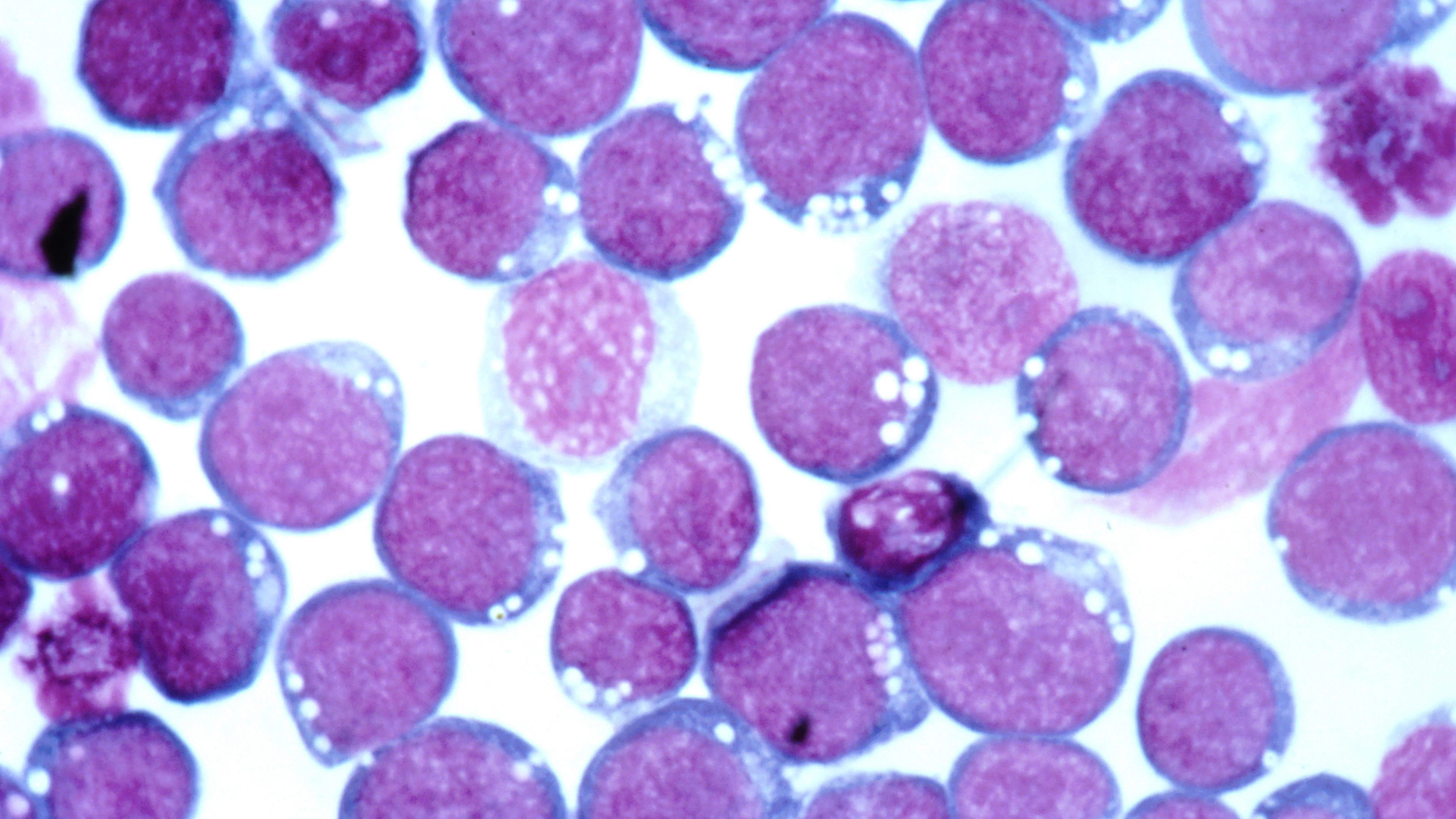 Nieuw onderzoek vindt puzzelstukje van link tussen Epstein-Barr-virus en MS