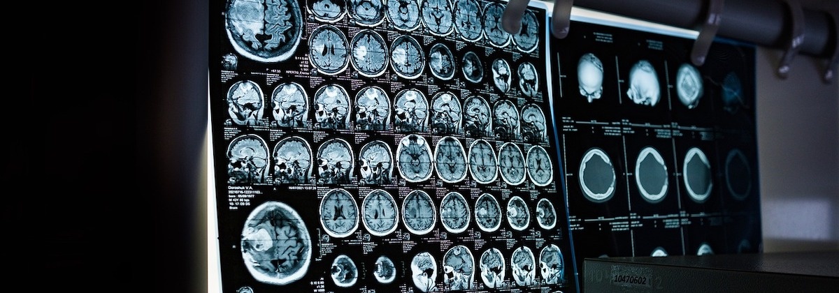 Gamen voor alzheimer
