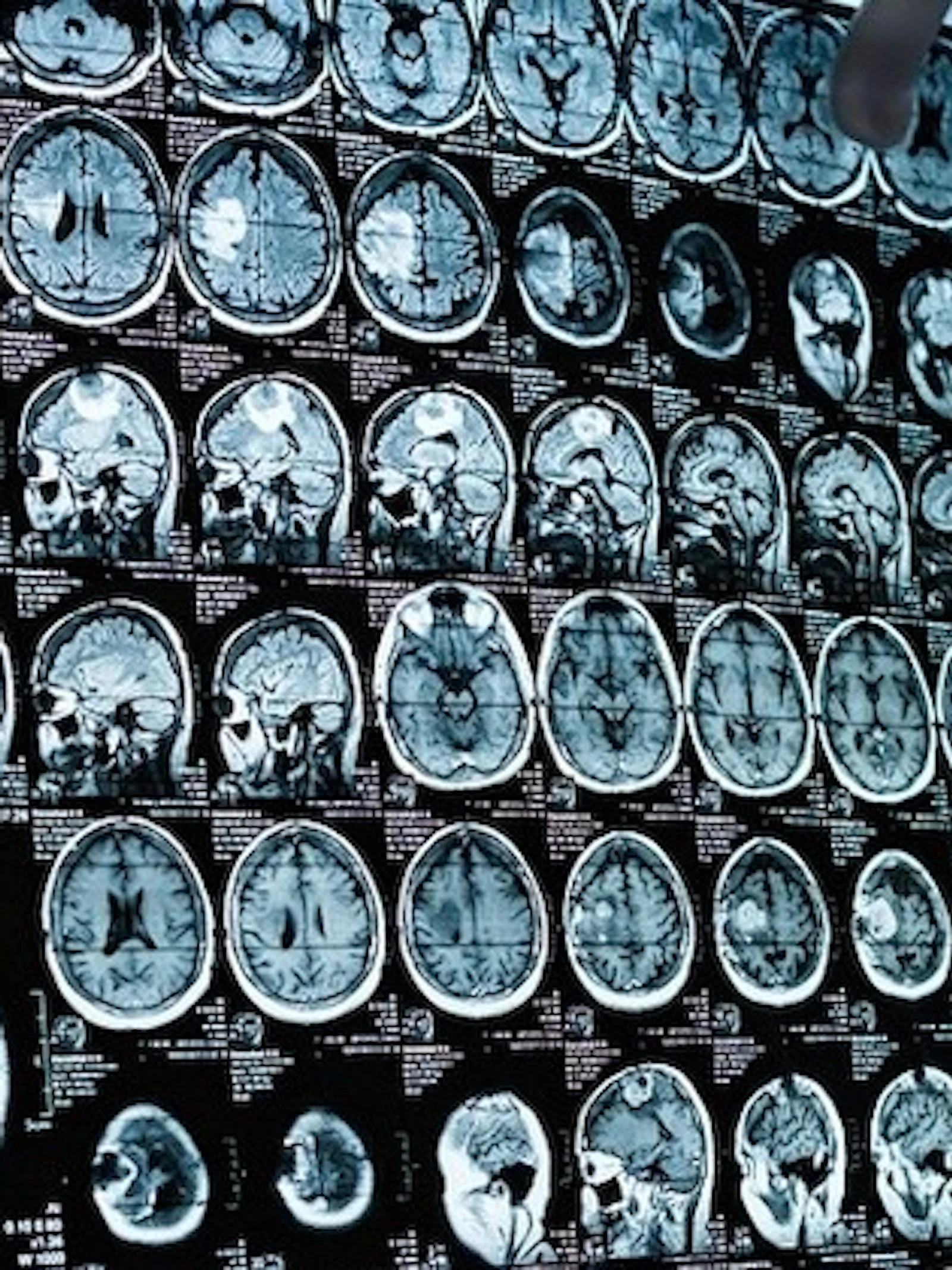 Gamen voor alzheimer