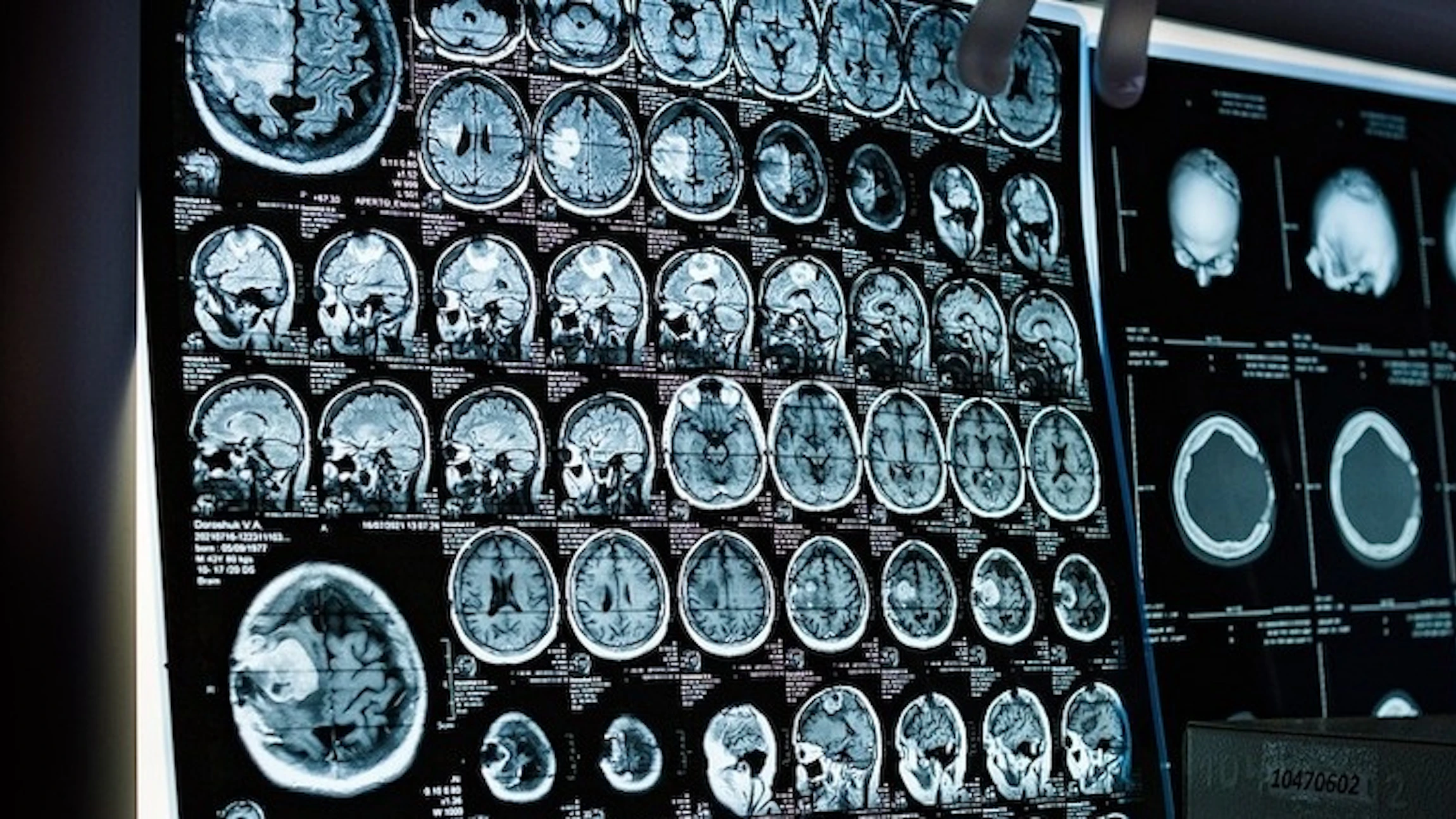 Gamen voor alzheimer