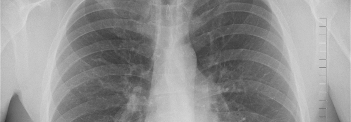 Help tuberculose de wereld uit