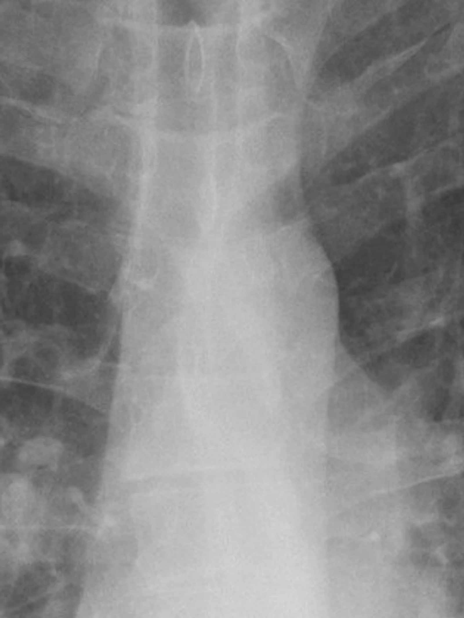 Help tuberculose de wereld uit