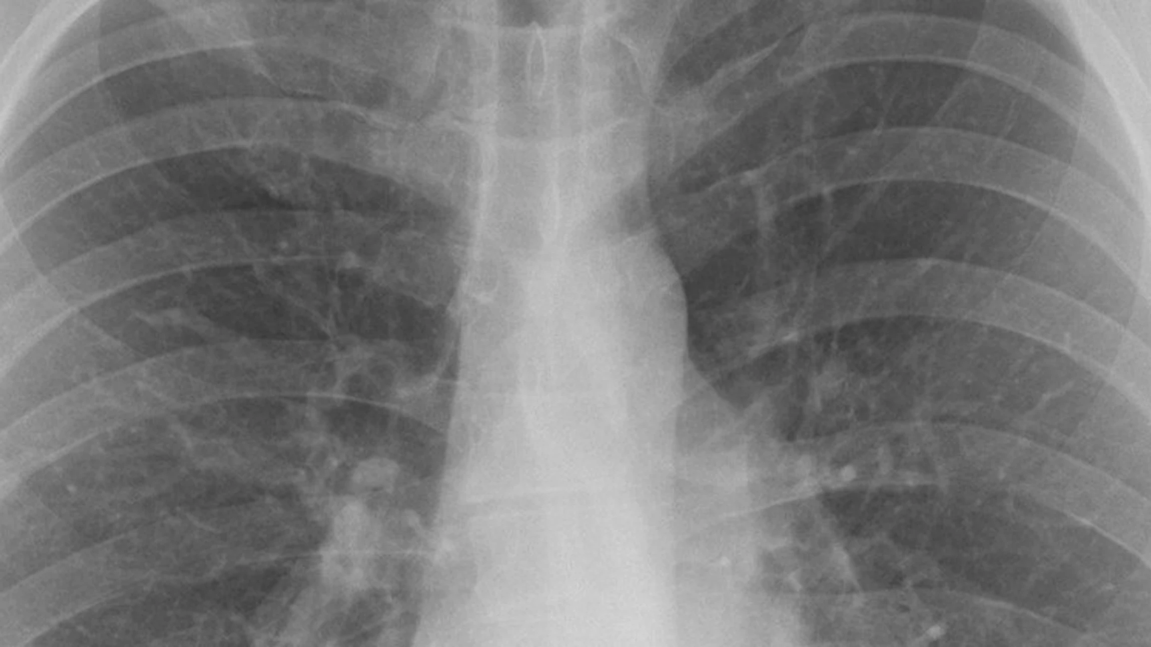 Help tuberculose de wereld uit