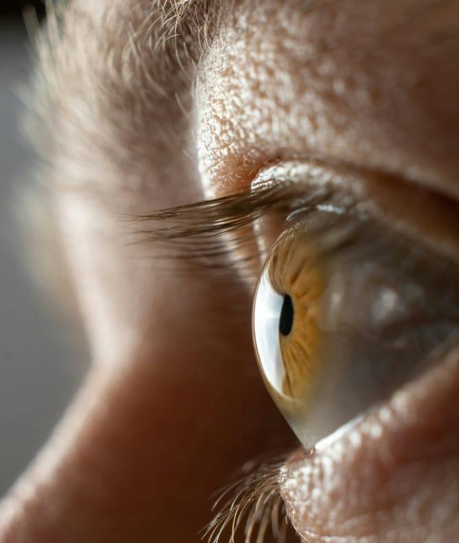 Intraocular lenses (IOLs)