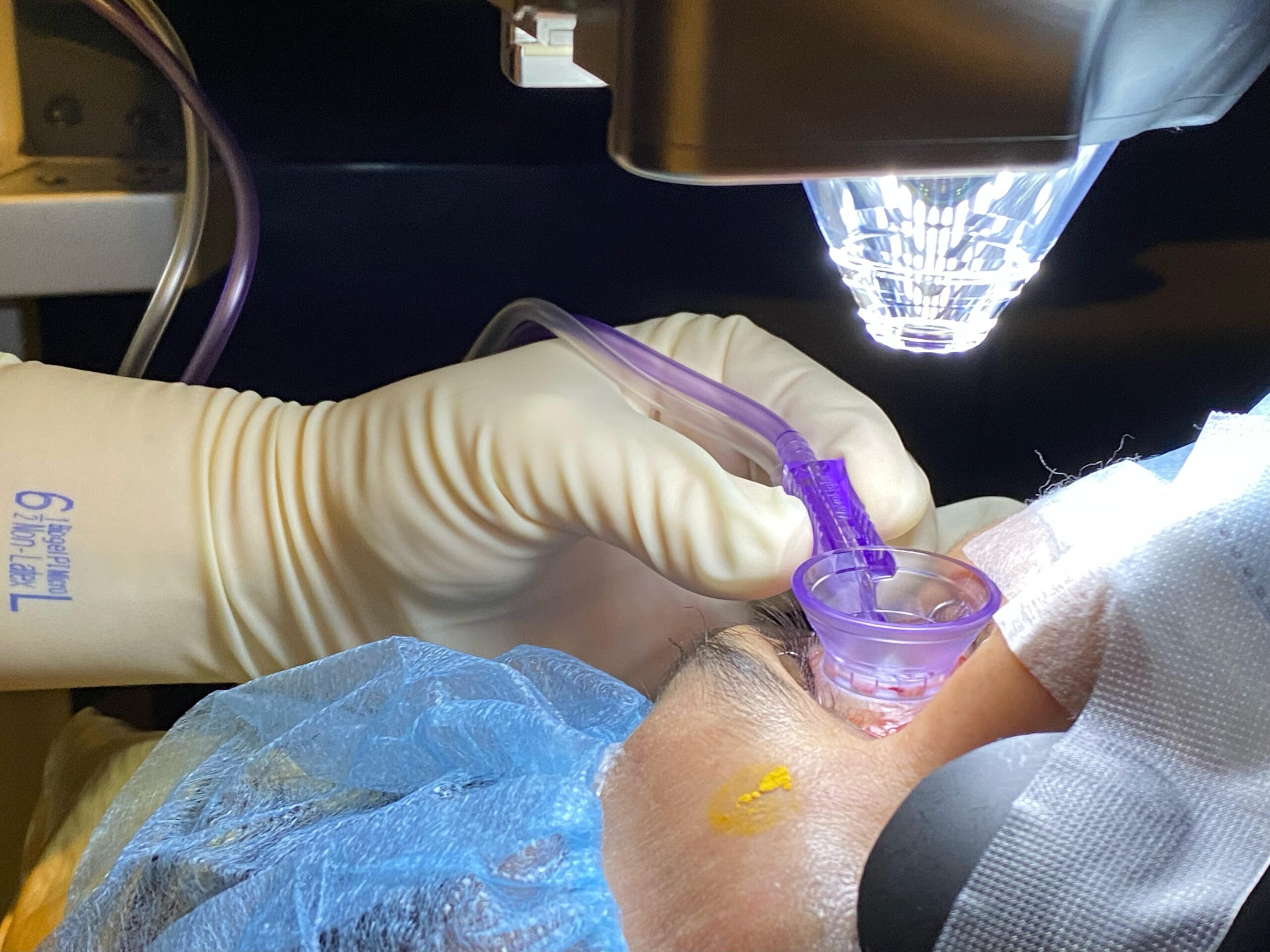 eye surgery
