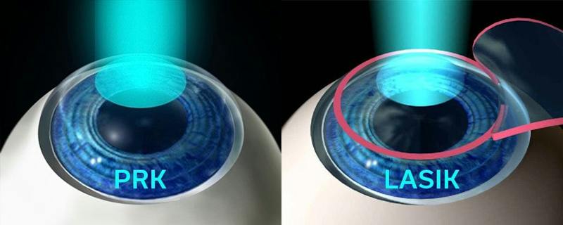 lasik vs prk