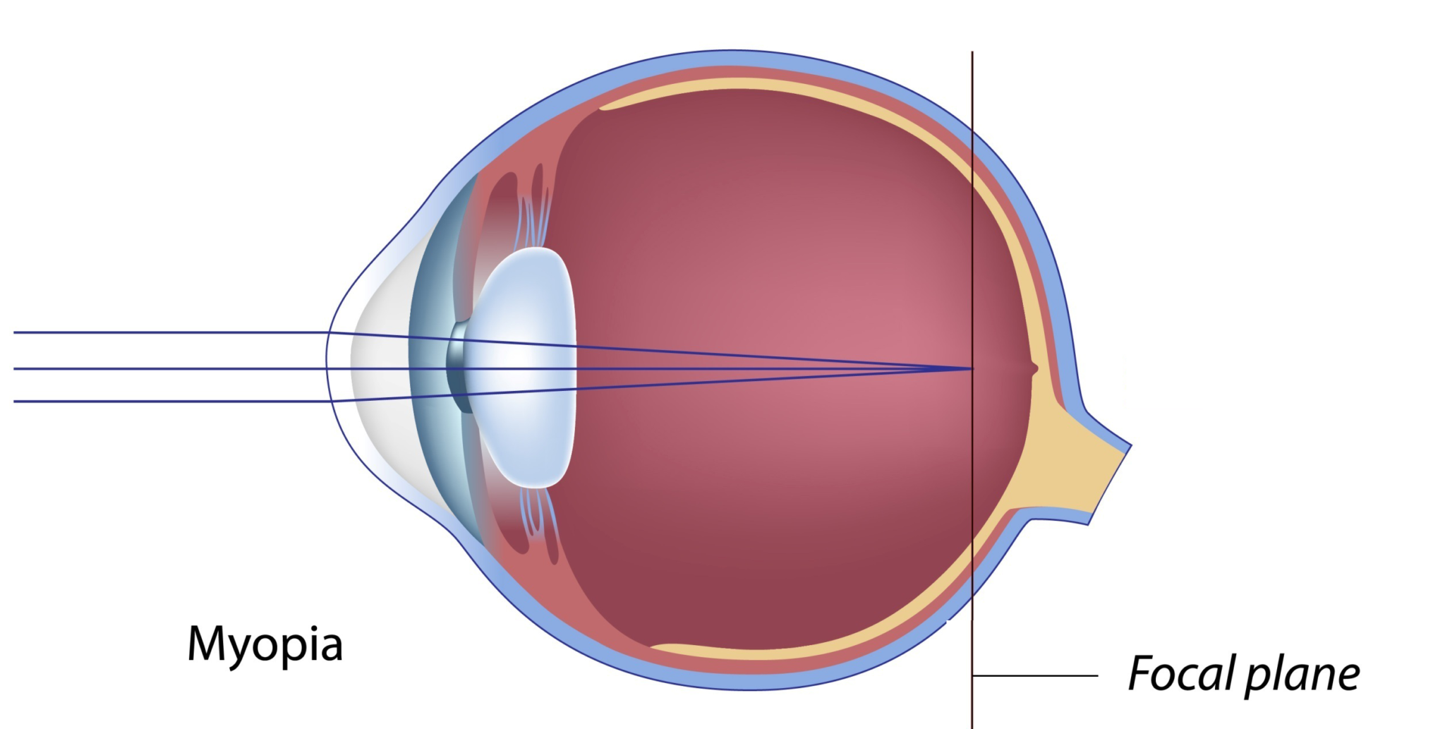 myopia