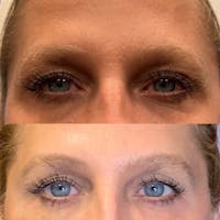 Instalift Threading Before & After Gallery - Patient 3198887 - Image 1