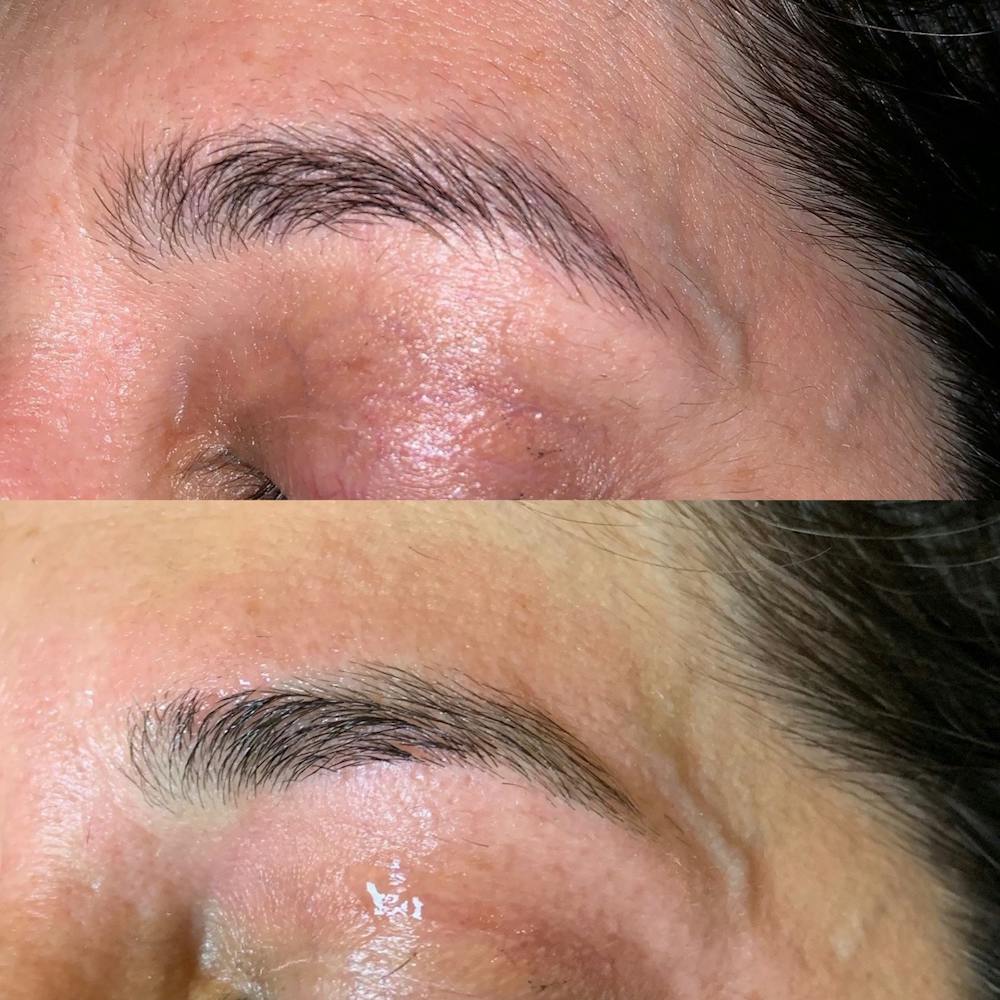 Brow Wax Before & After Gallery - Patient 3198996 - Image 1