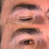 Brow Wax Before & After Gallery - Patient 3199001 - Image 1