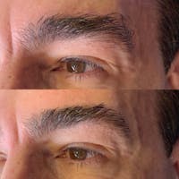 Brow Wax Before & After Gallery - Patient 3199002 - Image 1
