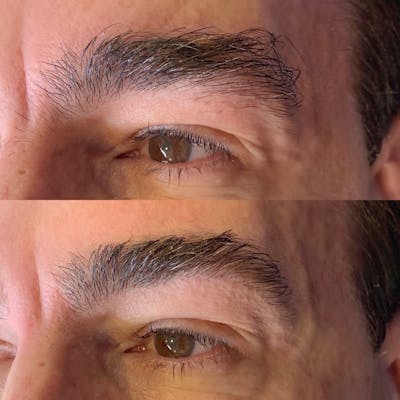 Brow Wax Before & After Gallery - Patient 3199002 - Image 1