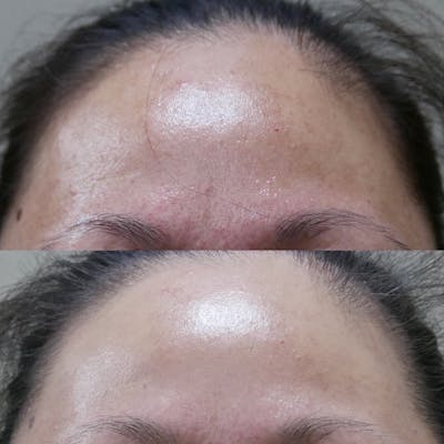 Chemical Peel Before & After Gallery - Patient 3199133 - Image 1