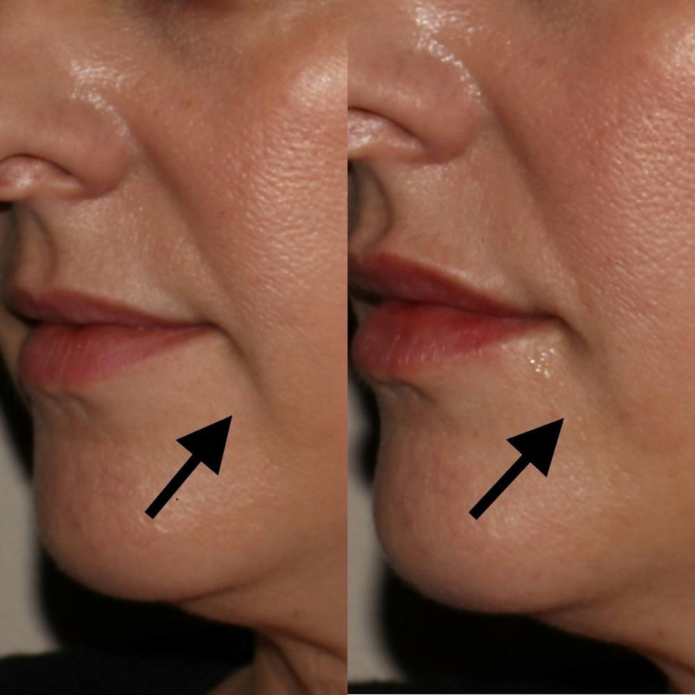 Dermal Fillers Before & After Gallery - Patient 3199252 - Image 1