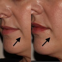 Dermal Fillers Before & After Gallery - Patient 3199252 - Image 1