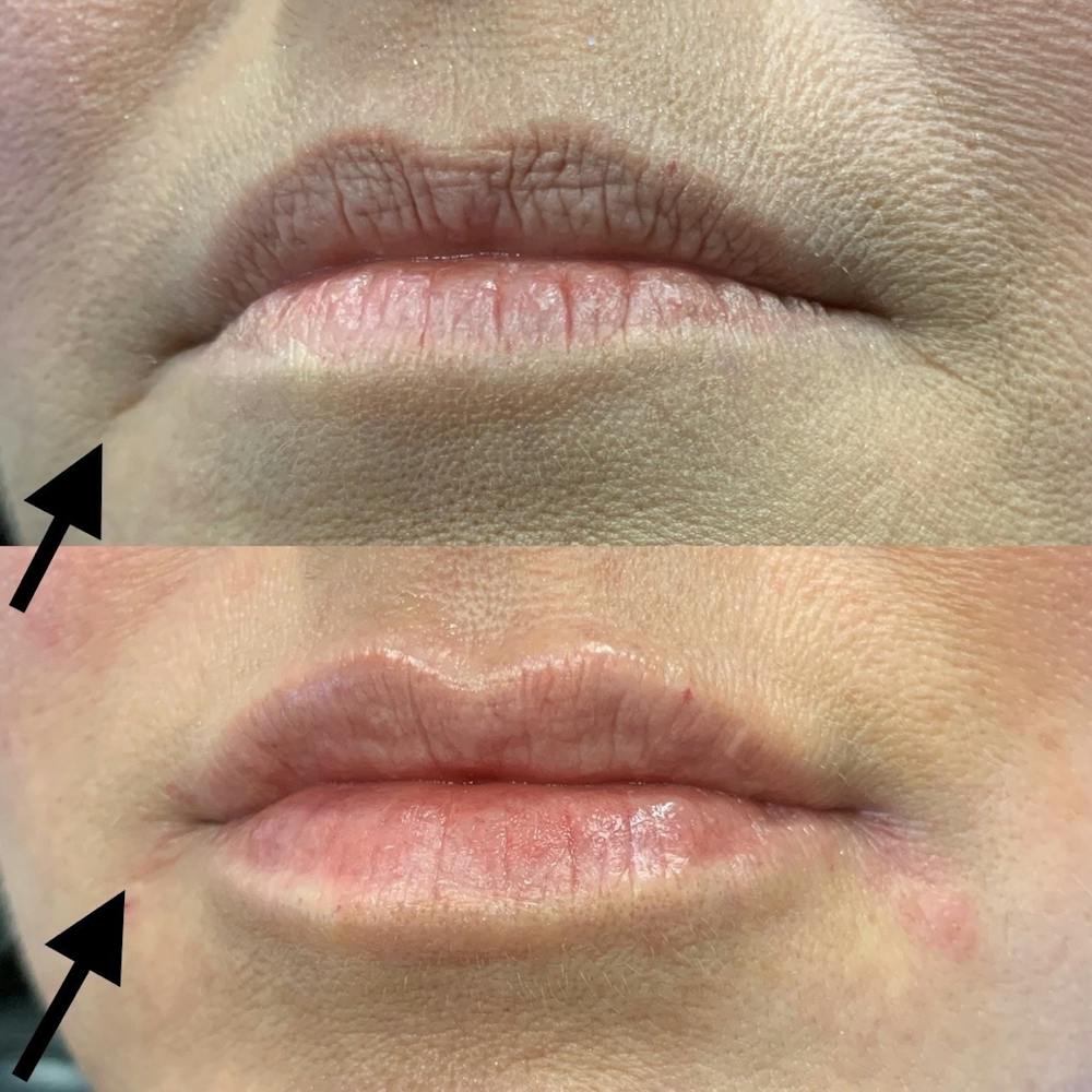 Dermal Fillers Before & After Gallery - Patient 3199253 - Image 1
