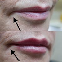 Dermal Fillers Before & After Gallery - Patient 3199255 - Image 1
