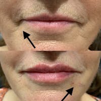 Dermal Fillers Before & After Gallery - Patient 3199256 - Image 1