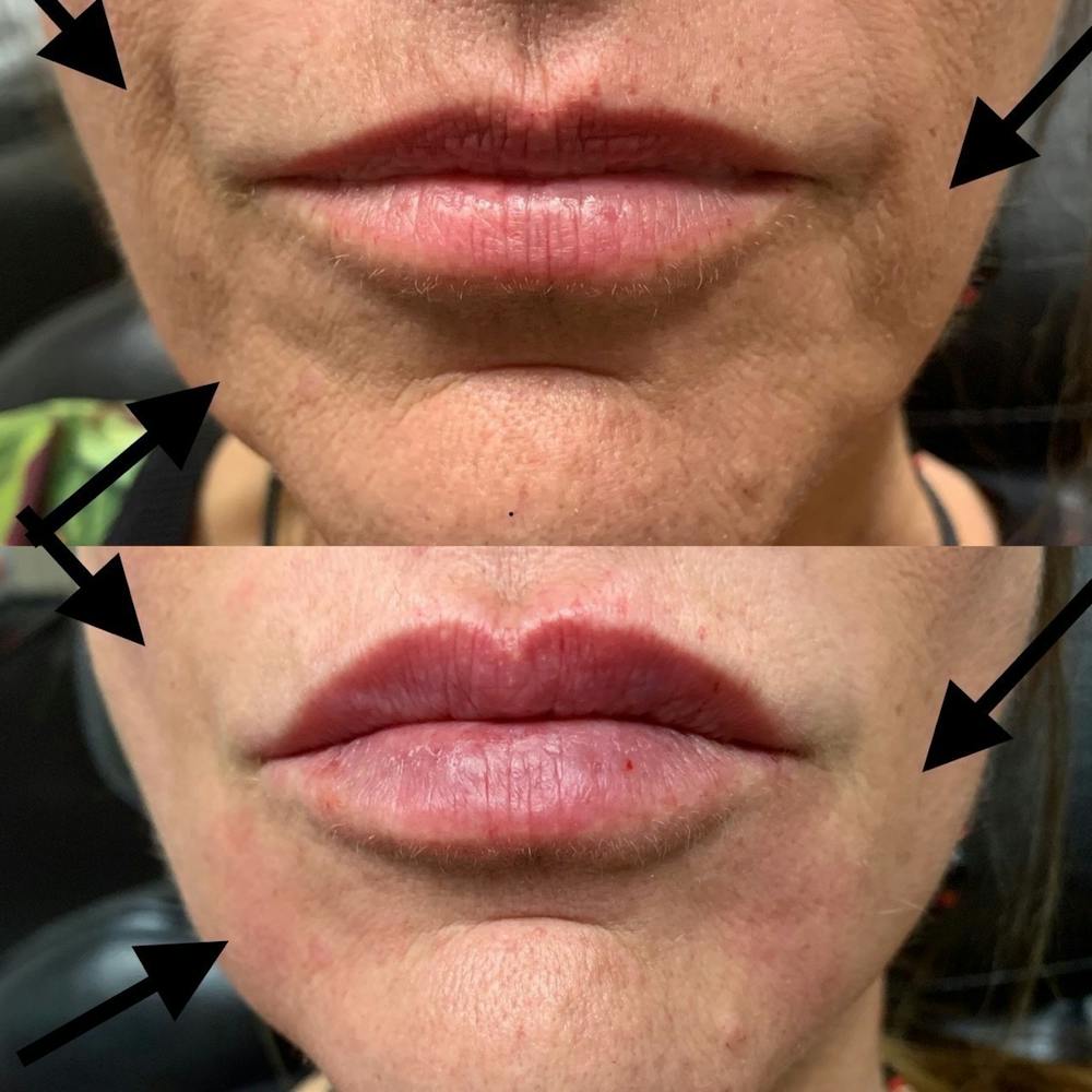 Dermal Fillers Before & After Gallery - Patient 3199257 - Image 1