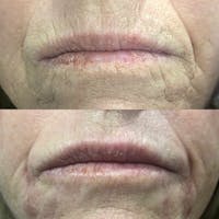 Dermal Fillers Before & After Gallery - Patient 3199259 - Image 1