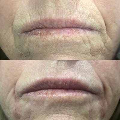 Dermal Fillers Before & After Gallery - Patient 3199259 - Image 1