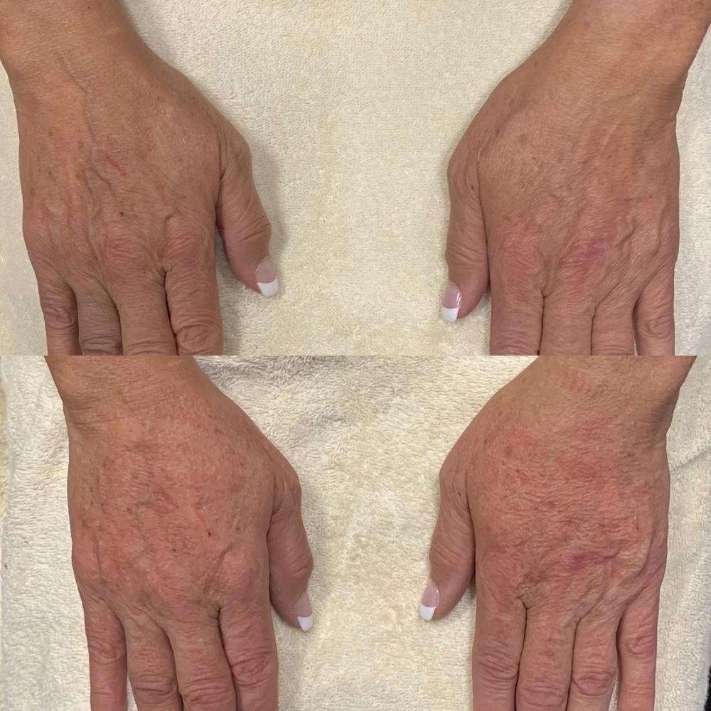 Hand Before & After Gallery - Patient 3199415 - Image 1