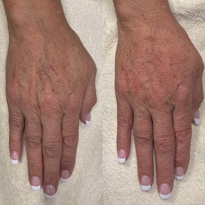 Hand Before & After Gallery - Patient 3199416 - Image 1