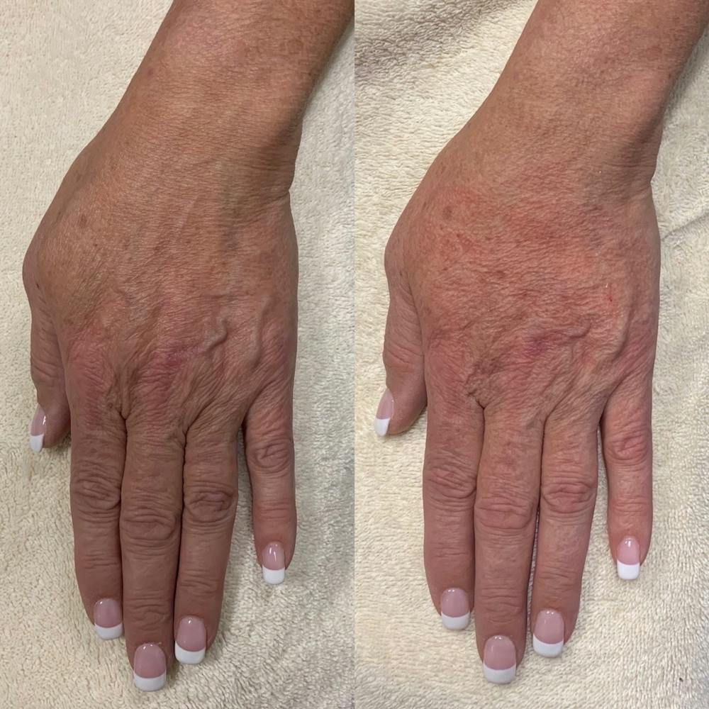 Hand Before & After Gallery - Patient 3199417 - Image 1