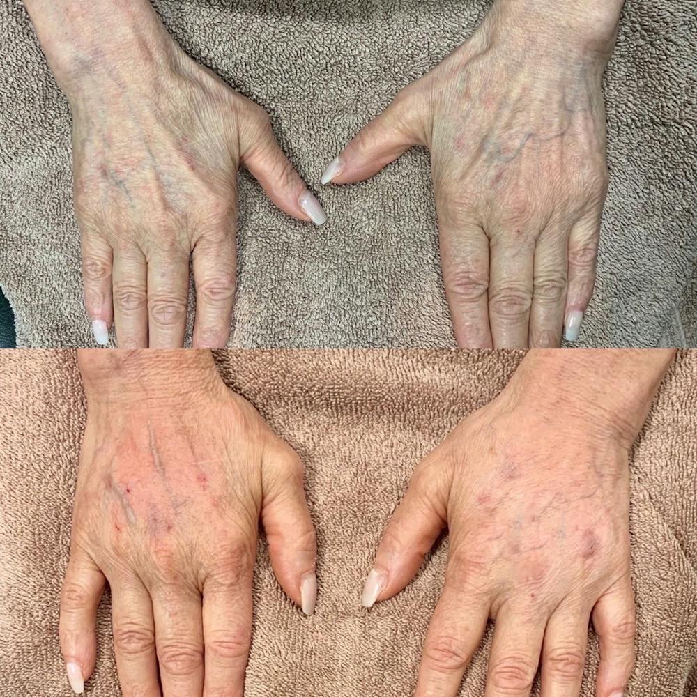 Hand Before & After Gallery - Patient 3199418 - Image 1