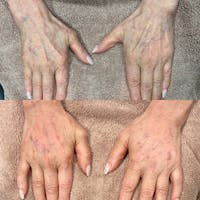 Hand Before & After Gallery - Patient 3199418 - Image 1