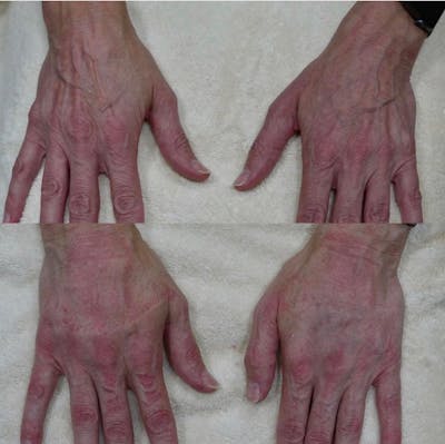 Hand Before & After Gallery - Patient 3199419 - Image 1