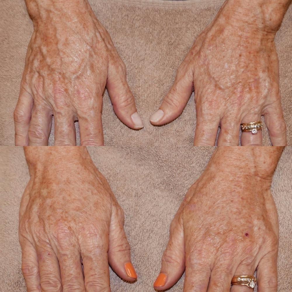 Hands Before & After Gallery - Patient 3199445 - Image 1