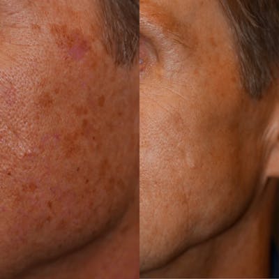 IPL Before & After Gallery - Patient 3199491 - Image 1