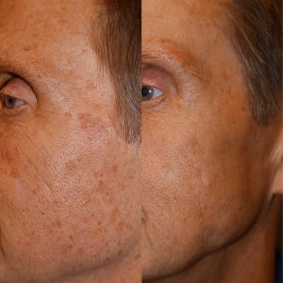 IPL Before & After Gallery - Patient 3199492 - Image 1